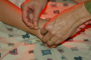 acupuncture treatment for a sports injury from gymnastics and ballet