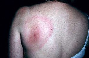 Bee Sting Picture (Hardin MD Super Site Samples)