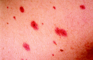Disseminated Varicella Zoster Virus Infection