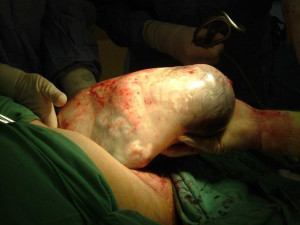 Breathtaking...a c-section birth of a baby born in the caul.