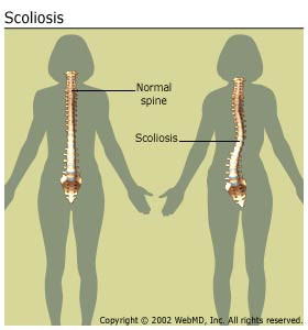 What Causes Scoliosis?