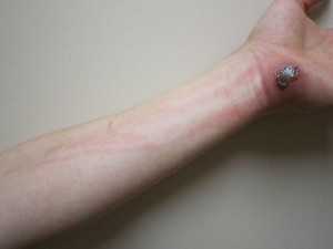 Cellulitis of the arm (Picture from Wikimedia Commons )