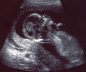 Weeks Baby Ultrasound Scanning