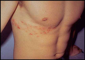 Download Case of Persistent Pain after an Attack of Shingles.
