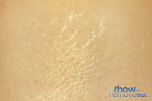 Stretch Marks Puberty Gone Fast