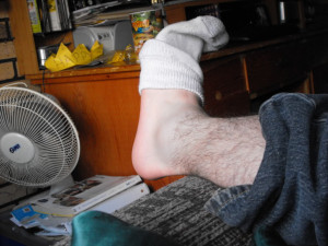 Broken Ankle Image Picture