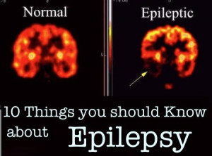 Must-know-things-about-epilepsy.jpg