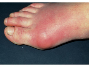 Gout Big Toe Joint
