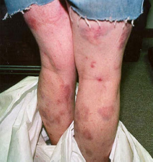The wounds on a meth addict’s skin come from scratching, picking ...
