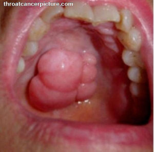 Throat Cancer Refers Health...