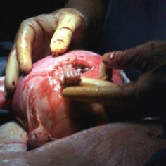 During surgery to correct spina bifida, 21 weeks into pregnancy, baby ...