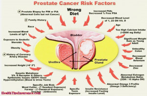 Early Sign Prostate Cancer