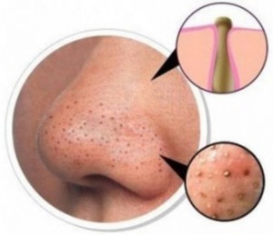 Source link: http://www.fahv.com/how-to-get-rid-of-blackheads-on-nose ...
