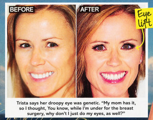 Trista Sutter Before and After Eye Surgery