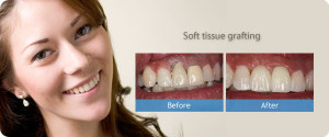 Home » General Dentistry » Dental Implants » Soft Tissue Grafting