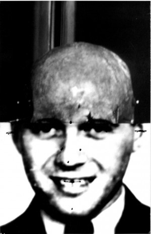Josef Mengele Twins Sewn Together Mengele's skull... it was an unusual ...