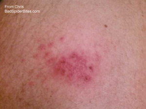 Symptoms Of Shingles On Neck