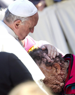 ... Kisses Man With Rare Disorder Showing The Healing Power Of Compassion