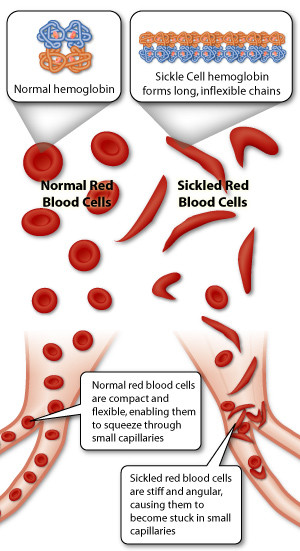 Sickle_cell_anemia Wallpaper