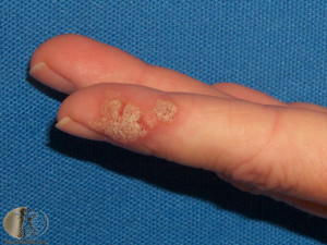 Viral Skin Infections Warts