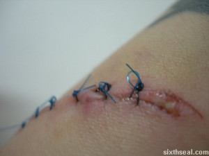 It’s ironic that the most serious wound (the one that pieced through