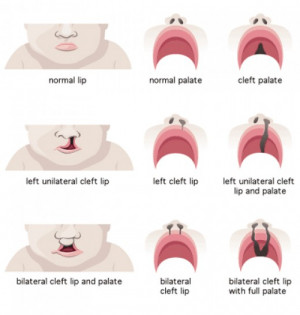 The three categories of cleft lip or cleft palate
