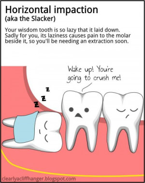 Symptoms of Impacted Wisdom Tooth that Needed to be Removed