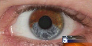 There Is A Laser Surgery That Can Permanently Change Eye Color