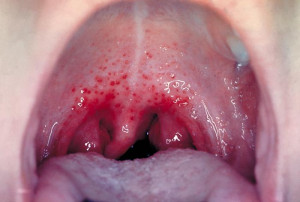 Images, Pics, Pictures and Photos of Gonorrhea Throat