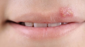 Dicas para curar o herpes labial de forma natural