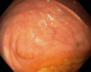 Caecum and the appendix aperture, a normal endoscopic finding