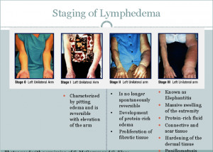 Oncology Breast Cancer Surgical Treatment Plications And Lymphedema