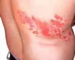 Zostavax vaccine for shingles approved for people 50 to 59 years old