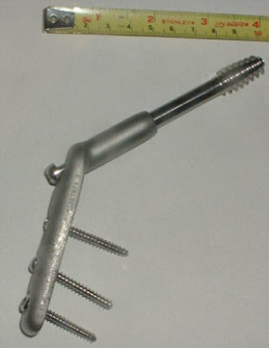 This is the type of hardware used to hold the bone together.