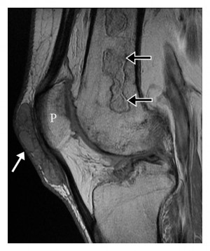 Gout Knee MRI