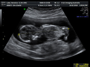 Baby at 13 Weeks Ultrasound