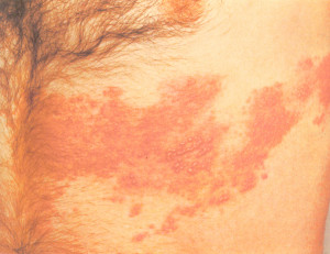Herpes_zoster.jpg
