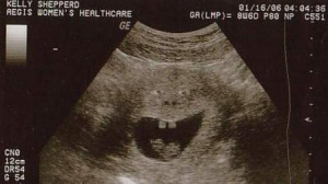 babyultrasound