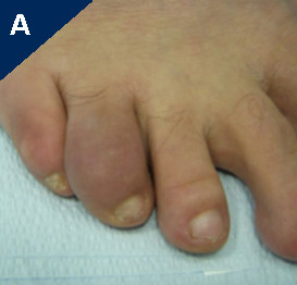 Psoriatic Arthritis Toe