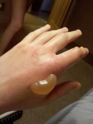 Burn That Blisters On Hands