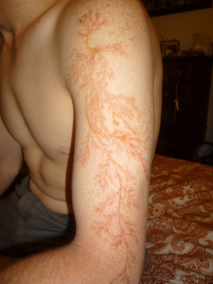 Amazing Lightning Scars