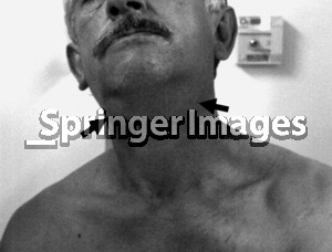 CT Submandibular Gland Infection