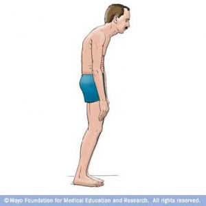 ankylosing spondylitis Images and Graphics