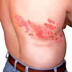 Home remedies for Shingles. Actually, this is a great site for home ...