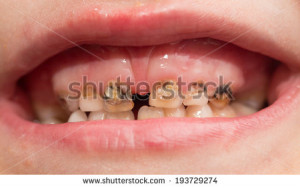 rotten teeth. macro - stock photo