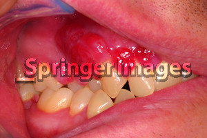 advanced periodontal disease