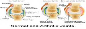 rheumatoid arthritis is a form of inflammatory arthritis and an ...