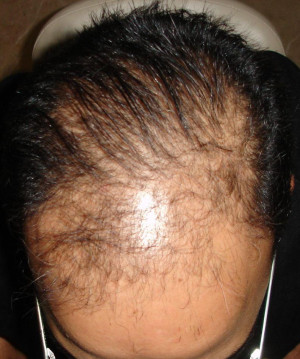 Before Fue Hair Transplant