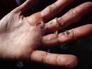Compare and contrast with the 50km Boston Marathon blisters pic below.