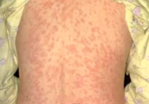 Measles Morbilliform Rash